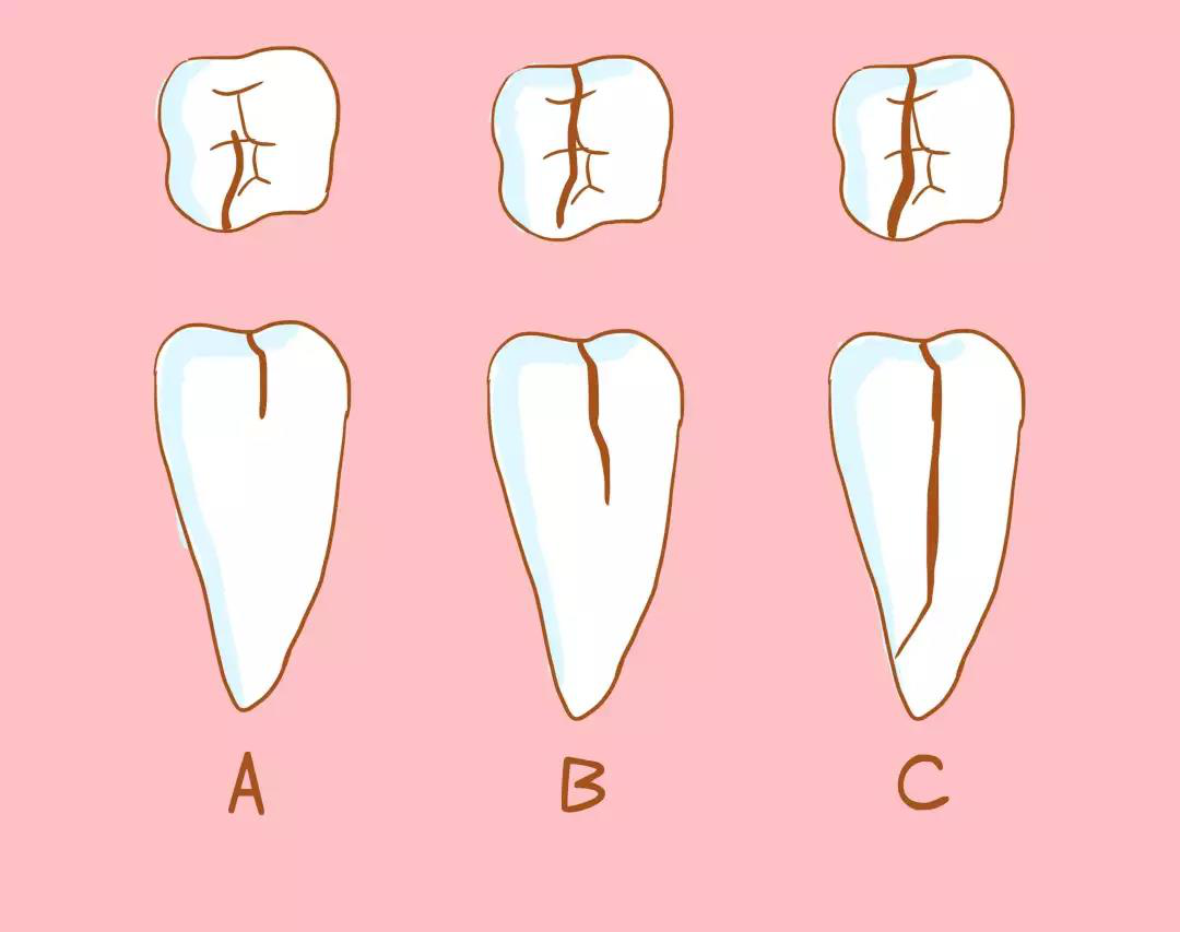 一般,裂纹分为三种:三,牙隐裂有什么症状?2,喜欢用牙齿去咬硬东西.